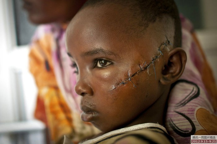Cô bé 9 tuổi Jamila Yakobo ở Kenya bị một nhóm người dùng dao rựa tấn công khi xung đột sắc tộc nổ ra ở đất nước này